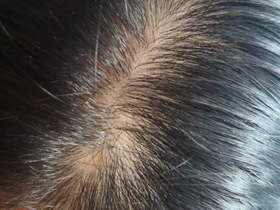 雄激素性脫髮頭髮稀疏發縫寬圖 雄激素性脫髮頭髮稀疏發縫寬圖