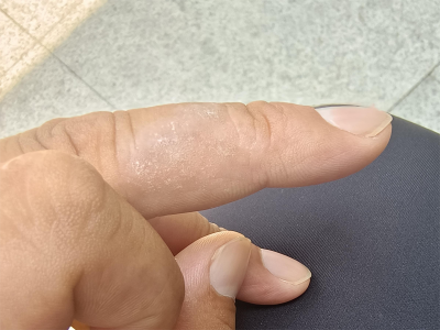 手部濕疹手指上出現白色皮屑圖 手部濕疹手指上出現白色皮屑圖