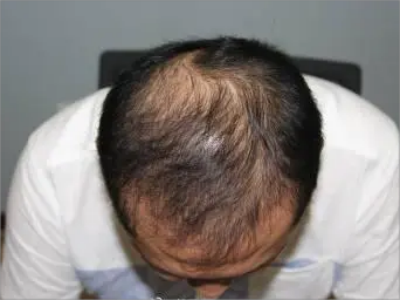 男性型脫髮頭頂毛髮稀疏圖