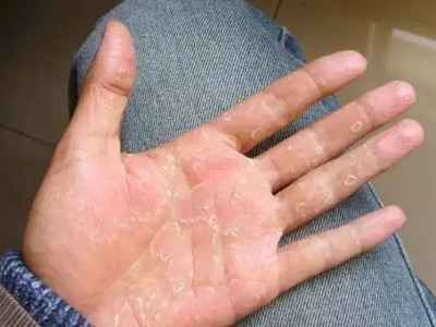 手足皸裂手掌一片一片的脫皮圖 手足皸裂手掌一片一片的脫皮圖