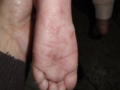 嬰兒肢端膿皰病腳底長丘疹和水皰圖