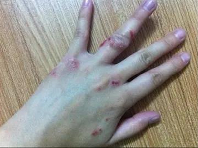 著色真菌病手背部起紅色丘疹糜爛圖 著色真菌病手背部起紅色丘疹糜爛圖