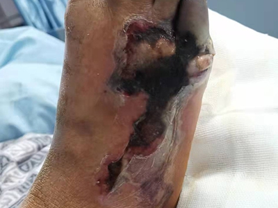 糖尿病性皮膚病腳部發黑潰爛圖 糖尿病性皮膚病腳部發黑潰爛圖