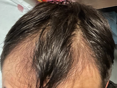 雄激素性脫髮髮際線後移呈M型圖 雄激素性脫髮髮際線後移呈M型圖