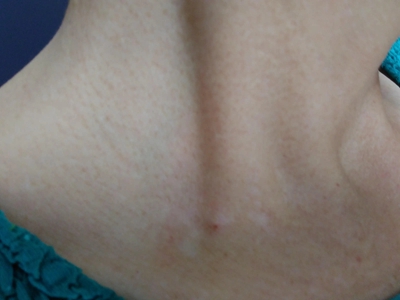 特發性滴狀色素減少症頸部白斑點圖 特發性滴狀色素減少症頸部白斑點圖