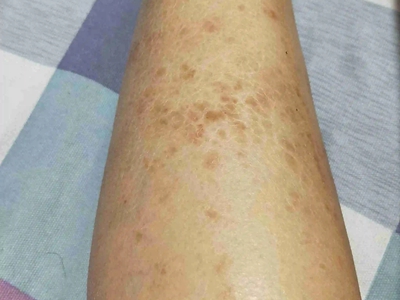 網狀肢端色素沉著小腿上斑塊裂紋圖 網狀肢端色素沉著小腿上斑塊裂紋圖