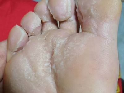 窩狀角質松解症右腳掌皮膚發白隆起圖 窩狀角質松解症右腳掌皮膚發白隆起圖