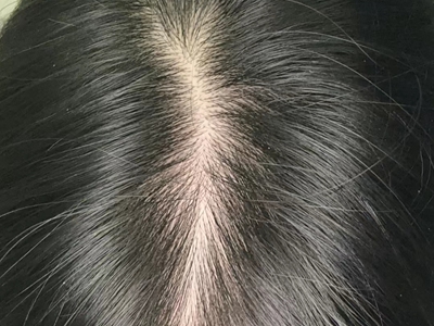 雄激素性脫髮發縫兩側頭髮減少圖 雄激素性脫髮發縫兩側頭髮減少圖