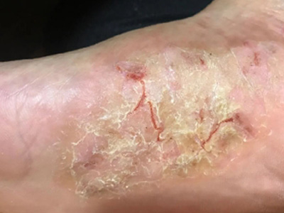 手足皸裂腳底結黃痂乾裂出血圖 手足皸裂腳底結黃痂乾裂出血圖