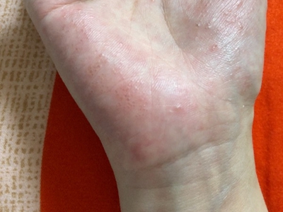 手部濕疹手掌有發紅的小水皰圖 手部濕疹手掌有發紅的小水皰圖
