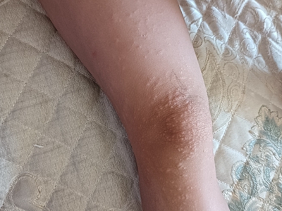 線狀苔蘚大腿有密集丘疹圖