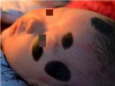 獸皮痣嬰兒面部卵圓形黑斑圖