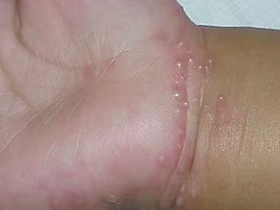 嬰兒肢端膿皰病手腕長很多水皰圖