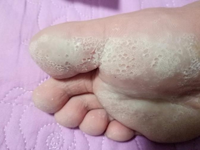 溝狀跖部角質松解症腳底發白有小坑圖