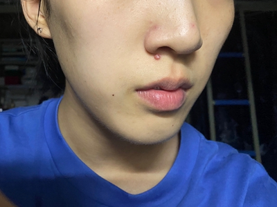 皮膚纖維瘤鼻子下面有一個小紅疙瘩圖 皮膚纖維瘤鼻子下面有一個小紅疙瘩圖