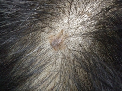 光線性角化病頭皮上長淡褐色斑塊圖 光線性角化病頭皮上長淡褐色斑塊圖