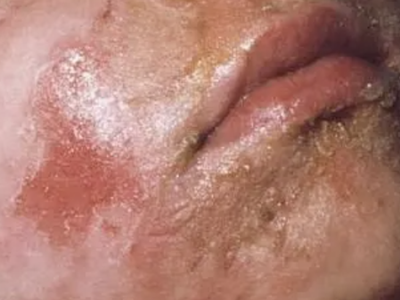 急性期口周濕疹嘴邊皮膚流黃水結痂圖 急性期口周濕疹嘴邊皮膚流黃水結痂圖
