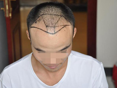 雄激素性脫髮前額兩邊頭髮全禿了圖 雄激素性脫髮前額兩邊頭髮全禿了圖