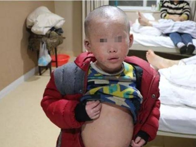 先天性外胚葉發育不良眉毛毛髮稀少圖 先天性外胚葉發育不良眉毛毛髮稀少圖