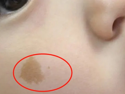 咖啡斑臉上有圓形的淺咖啡色斑圖 咖啡斑臉上有圓形的淺咖啡色斑圖