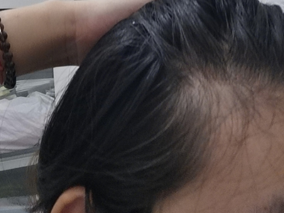 雄激素性脫髮額頭側面缺少頭髮圖