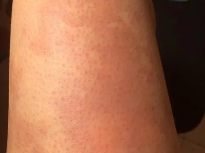 海鮮過敏大腿出現大片紅斑圖