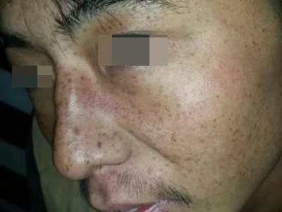雀斑面部有密密麻麻的褐色斑點圖 雀斑面部有密密麻麻的褐色斑點圖
