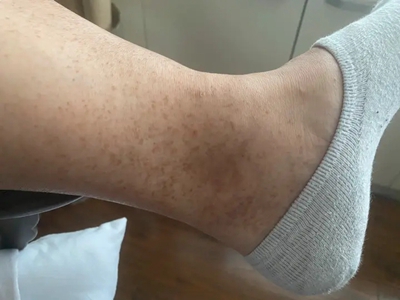 網狀肢端色素沉著腳踝有很多褐斑圖 網狀肢端色素沉著腳踝有很多褐斑圖