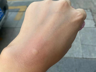 蚊子叮咬手背起圓疙瘩紅斑圖 蚊子叮咬手背起圓疙瘩紅斑圖