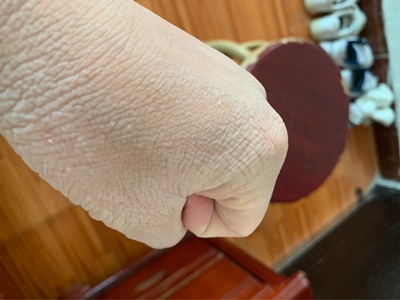 窩狀角質松解症手背皮膚粗糙糜爛圖