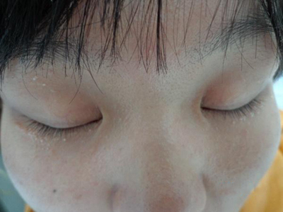 原發性粟丘疹眼睛周圍有白色丘疹圖