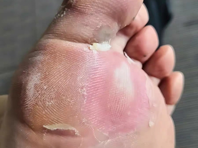 胼胝腳底脫皮有發黃和發白的硬塊圖 胼胝腳底脫皮有發黃和發白的硬塊圖