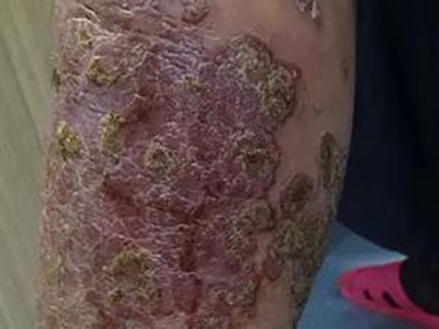 泛發性膿皰型銀屑病胳膊紅斑結厚痂圖 泛發性膿皰型銀屑病胳膊紅斑結厚痂圖