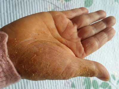 手部濕疹手掌皮膚增厚起鱗屑圖 手部濕疹手掌皮膚增厚起鱗屑圖