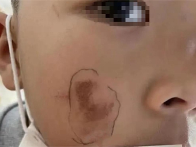 咖啡斑臉上有一片明顯的深色斑片圖 咖啡斑臉上有一片明顯的深色斑片圖