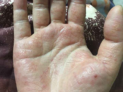 手部濕疹手掌皮膚顏色加深有疙瘩圖 手部濕疹手掌皮膚顏色加深有疙瘩圖