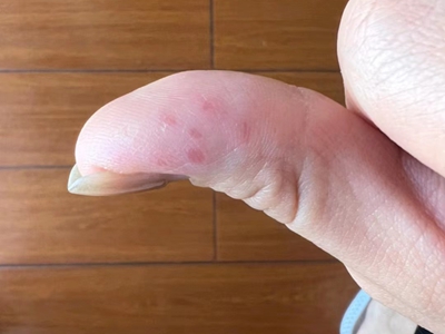 手部濕疹手指出現幾個紅色水皰圖