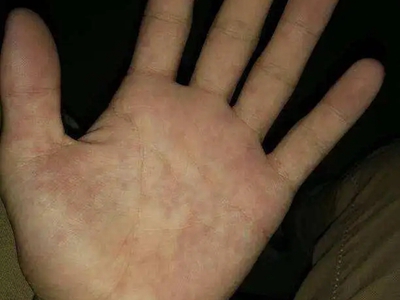 網狀肢端色素沉著手掌長褐色斑圖