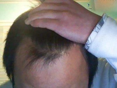 男性型脫髮額頭兩邊頭髮脫落圖