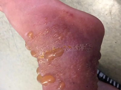 職業性光變應性接觸性皮炎腳踝水皰圖 職業性光變應性接觸性皮炎腳踝水皰圖