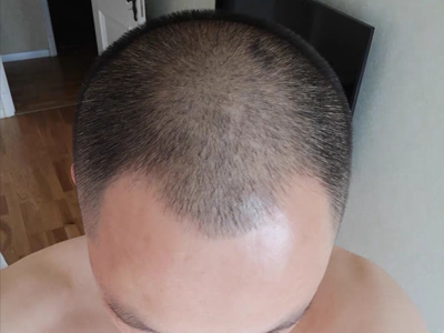 雄激素性脫髮前額髮際線變成M形圖 雄激素性脫髮前額髮際線變成M形圖