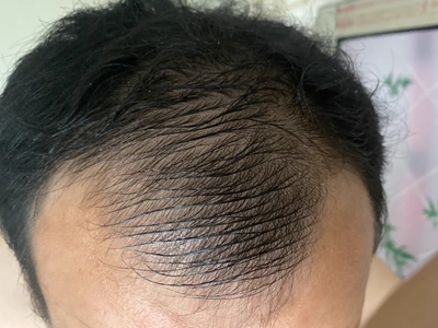 雄激素性脫髮前額角嚴重脫髮圖 雄激素性脫髮前額角嚴重脫髮圖