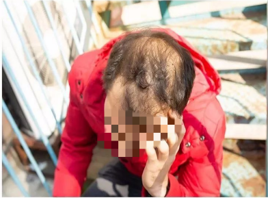 雄激素性脫髮頭頂的頭髮大量脫落圖 雄激素性脫髮頭頂的頭髮大量脫落圖
