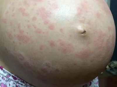 色素性痒疹腹部出現紅色風團圖 色素性痒疹腹部出現紅色風團圖