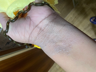窩狀角質松解症手腕皮膚粗糙發白圖