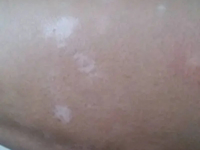 特發性滴狀色素減少症大腿白斑圖