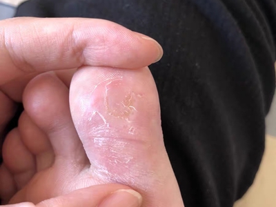 胼胝大腳趾底面發黃起皮圖 胼胝大腳趾底面發黃起皮圖