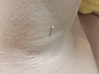 皮膚纖維瘤腋窩長個小肉粒圖