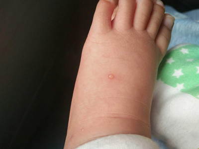 嬰兒肢端膿皰病腳背上一個小水皰圖 嬰兒肢端膿皰病腳背上一個小水皰圖