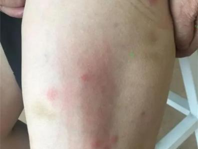 蠓蟲叮咬小腿上有疙瘩和抓痕圖